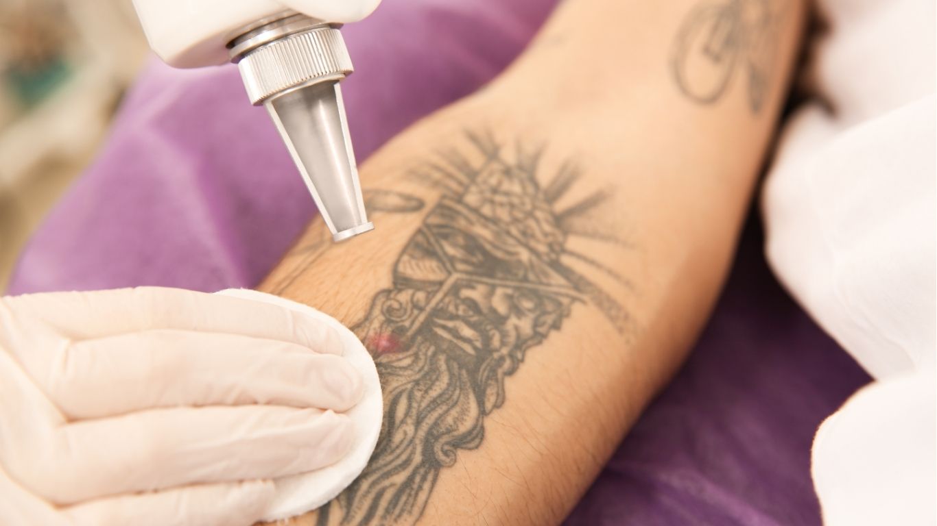 Tattoo removal